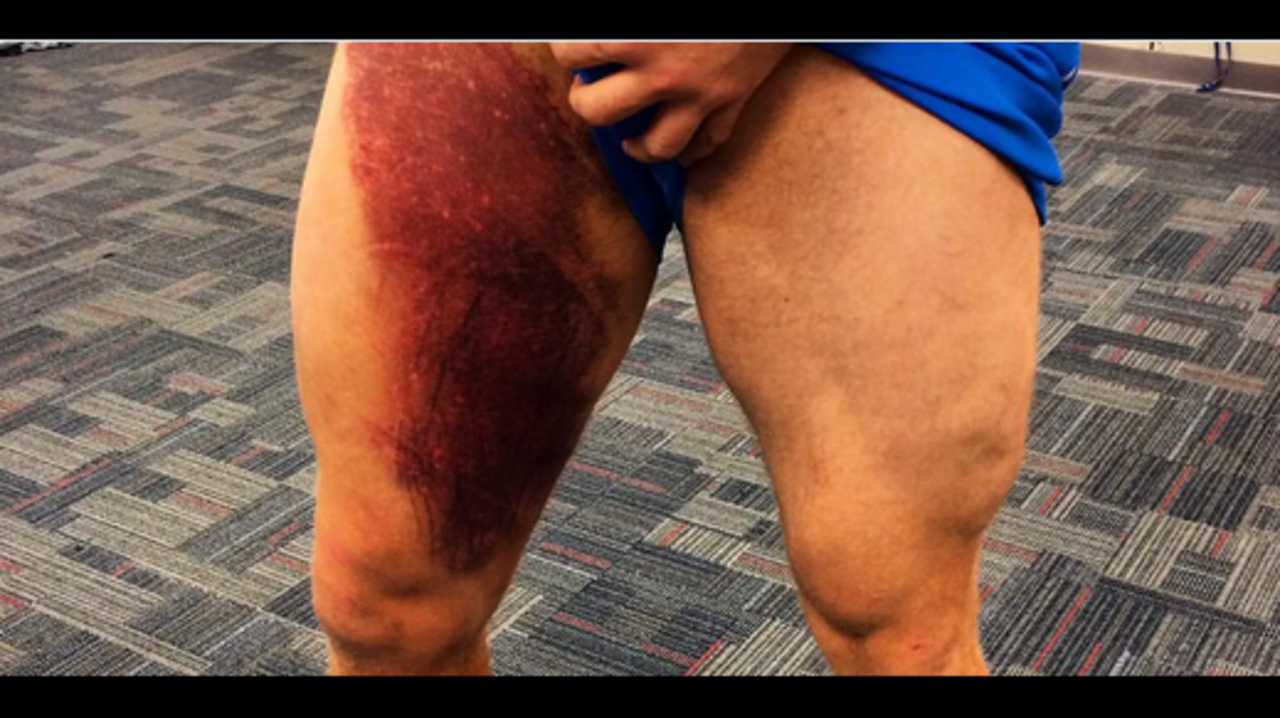 j j watt shares photo of thigh bruise from last season j j watt shares photo of thigh bruise from last season