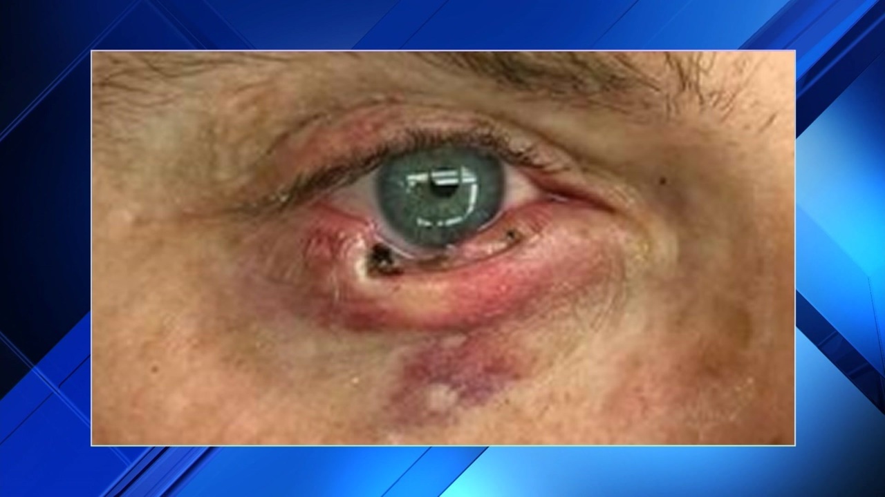 What to do with tumors on the eyelids (video recommendations) What to do with tumors on the eyelids (video recommendations)